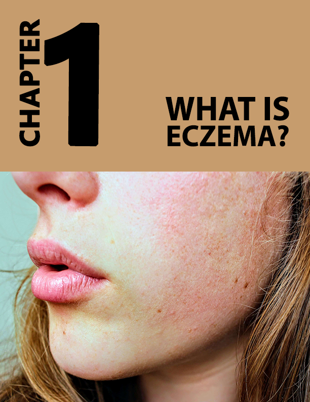 Eczema Fix: Your Guide to Managing and Controlling Eczema
