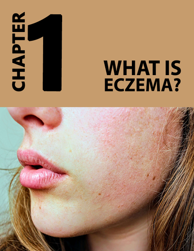 Eczema Fix: Your Guide to Managing and Controlling Eczema